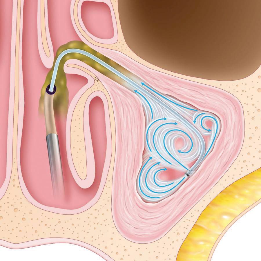 Usually only local anesthesia (lidocaine) is needed to ensure patient comfort during a balloon sinuplasty.