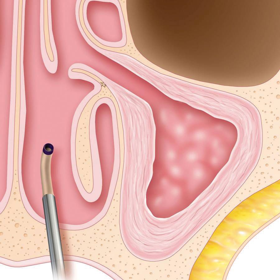 Usually only local anesthesia (lidocaine) is needed to ensure patient comfort during a balloon sinuplasty.