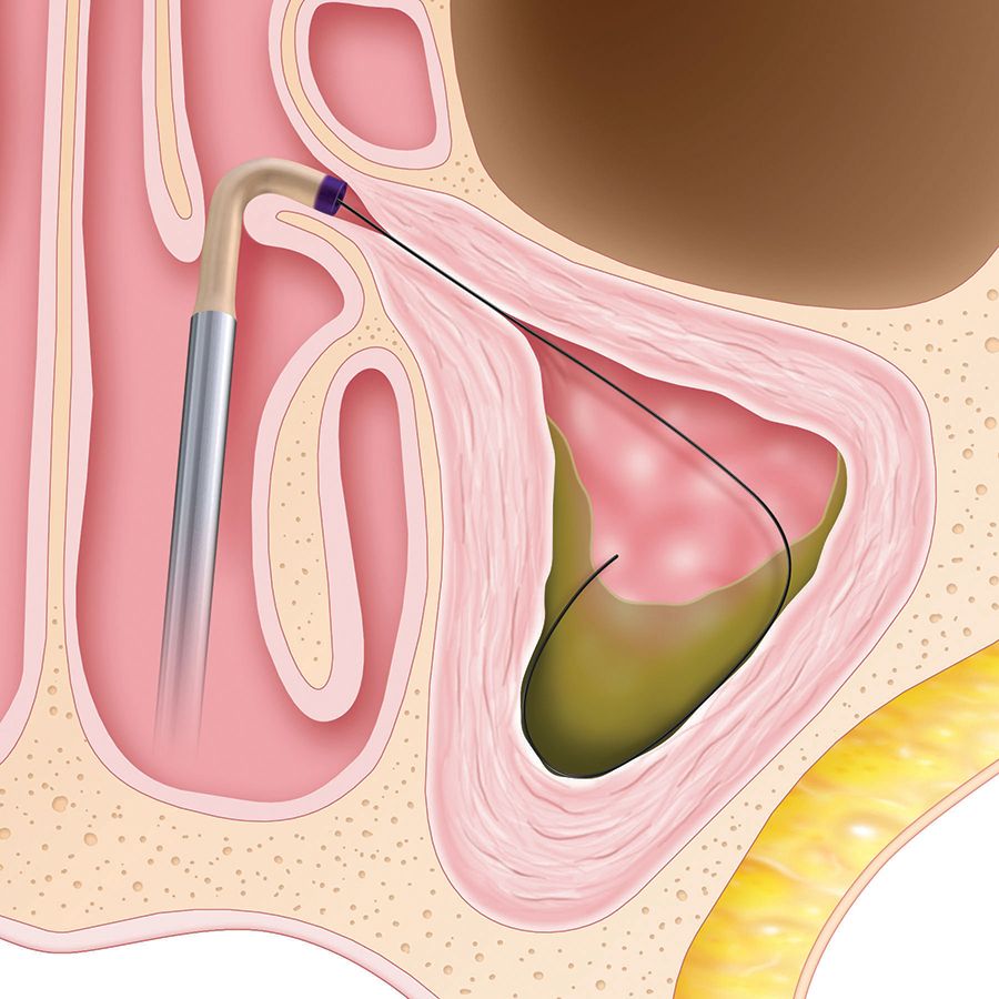 Usually only local anesthesia (lidocaine) is needed to ensure patient comfort during a balloon sinuplasty.