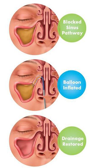  On the day of your procedure, you will be asked to rest comfortably in a procedure room where you will receive topical medications in your nose to help decongest and numb the area. This will be followed by the injection of numbing medicine (e.g., lidocaine) into the sinus areas