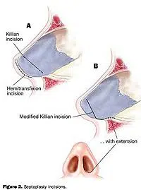  Septoplasty is a surgical procedure designed to correct a deviated (or “off-center”) septum which is contributing to nasal blockage. 