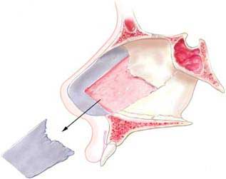 unobstructed nasal passage nj
This “Extracorporeal Septoplasty” is a more involved procedure and is usually accompanied by a longer recovery period. 