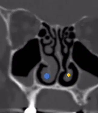 CT scan demonstrates enlarged right inferior turbinate (blue) compared to left Inferior turbinate (yellow)