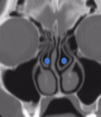 CT scans demonstrates concha bullosa (blue)