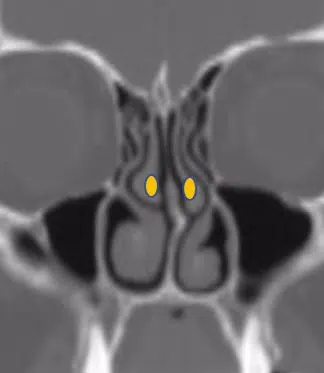 Normal middle turbinates (yellow)