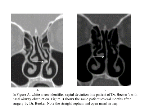 Septoplasty is an option for patients with septal deviation and persistent nasal obstruction that has not responded to medical therapy. 