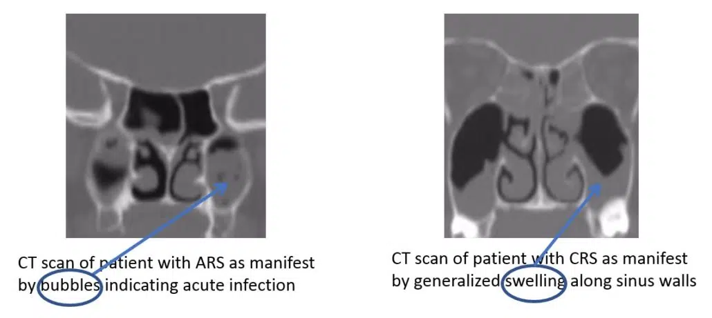 Sinusitis is typically classified as Acute or Chronic based on duration and symptomology.