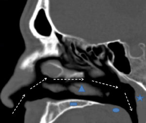 Sagittal CT view 