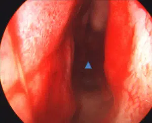 FIGURE 3 – Intraoperative view of the patient in FIGURE 2 shows the wide open nasal airway (triangle) after straightening of the deviated septum. 