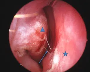 Endoscopic view into the right nasal cavity