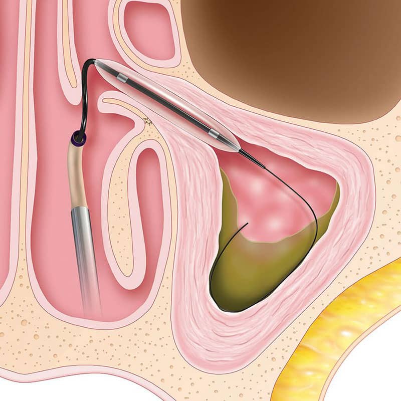 Usually only local anesthesia (lidocaine) is needed to ensure patient comfort during a balloon sinuplasty.