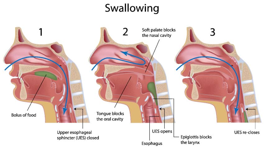 These are just some of the symptoms someone experiencing dysphagia may have, as there are many different types of swallowing disorders with various symptoms.