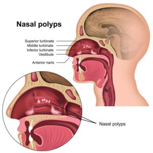 SINUVA is an implant that is designed for patients who are over the age of 18, have nasal polyps, and who have a history of ethmoid sinus surgery. This technology may be an option if you do not want to repeat sinus surgery.