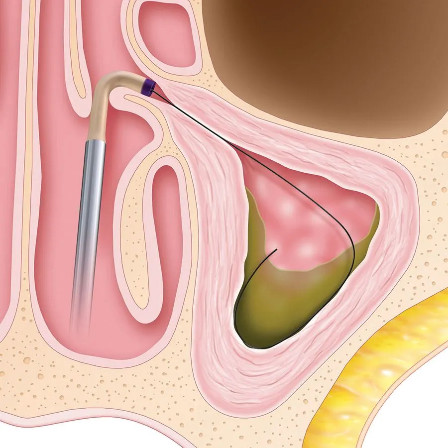 Usually only local anesthesia (lidocaine) is needed to ensure patient comfort during a balloon sinuplasty.