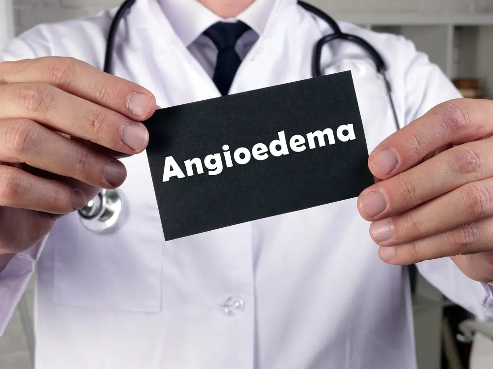 The Importance of Choosing the Right Doctor for Angioedema Treatment