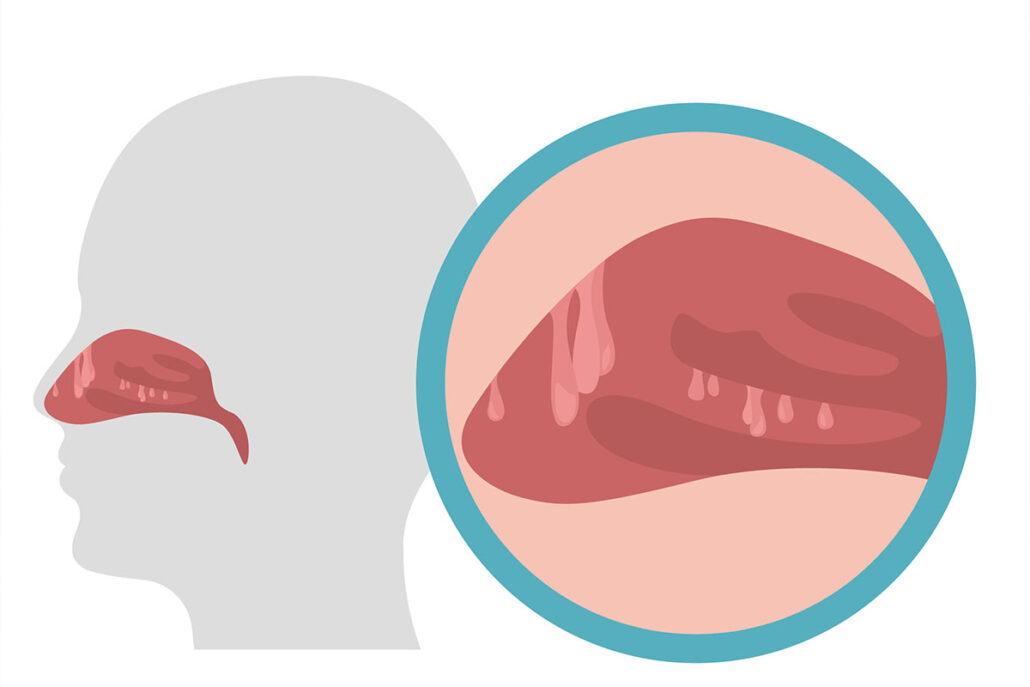 Nasal Polyps Symptoms may also include nasal discharge with a change in color, post-nasal drip, snoring issues, and decreased or loss of smell and taste sensation.