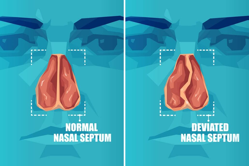 Fixing a deviated septum can also improve the overall quality of life by reducing snoring, improving sleep quality, and allowing for improved oxygen flow in the body.