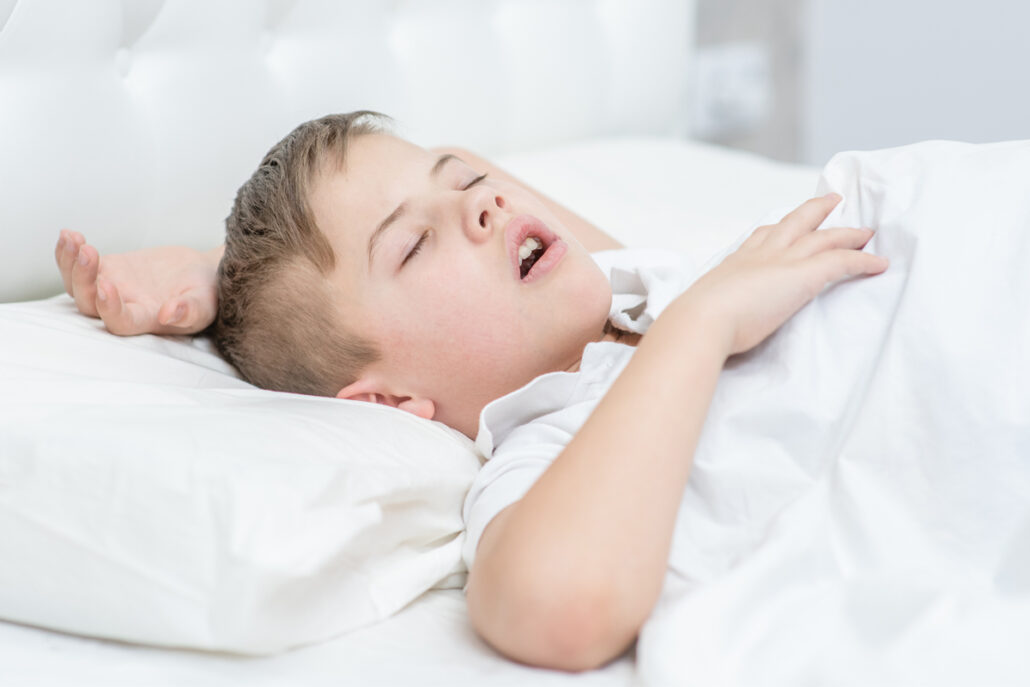 Sleep apnea is a common complication of a narrow airway in children, causing them to experience pauses in breathing during sleep.