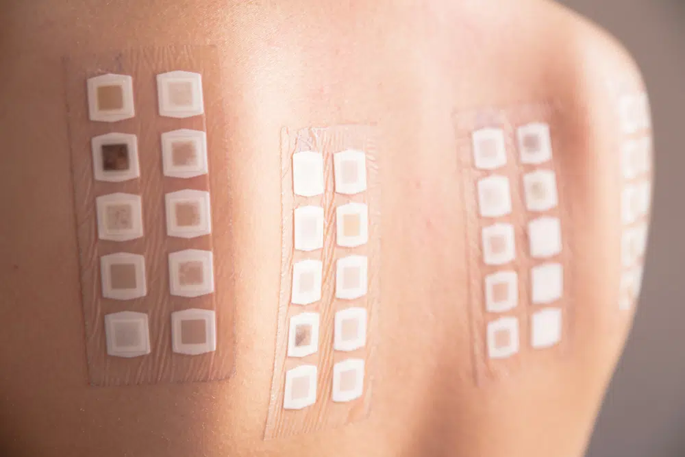 Identifying Allergens: Diagnosing Allergic Contact Dermatitis Through Patch Testing