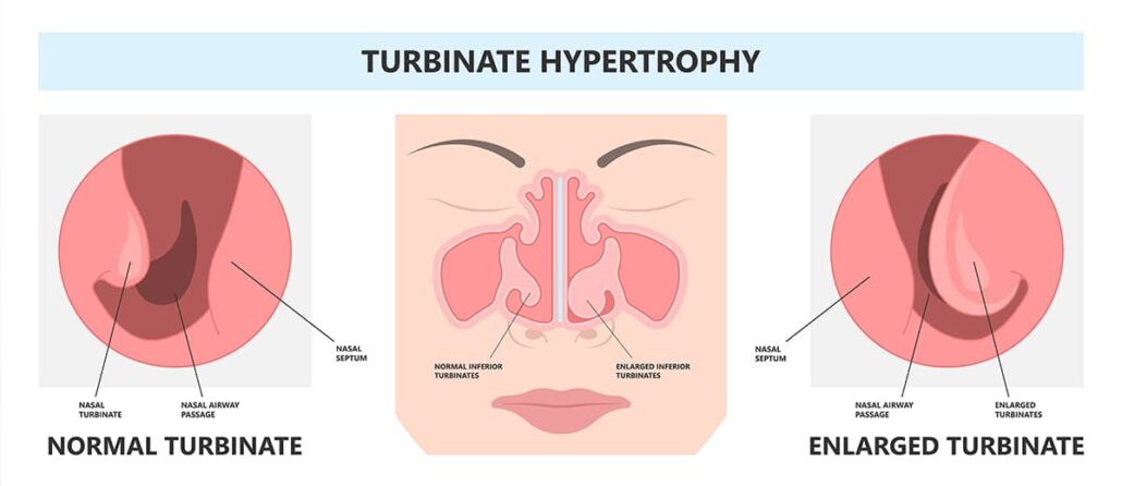 Inferior turbinate hypertrophy in children is a condition characterized by the enlargement of the inferior turbinates, which are small structures within the nose that help to warm and humidify the air. 