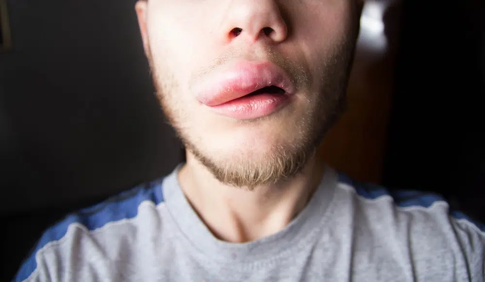 What Causes Angioedema and How to Identify the Symptoms