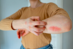 Common drugs causing rashes include antibiotics, anticonvulsants, and NSAIDs.