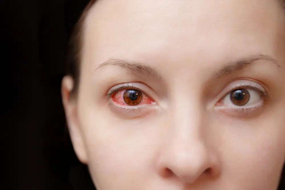 Redness, Itching, and Tears: Understanding the Signs of Allergic Conjunctivitis