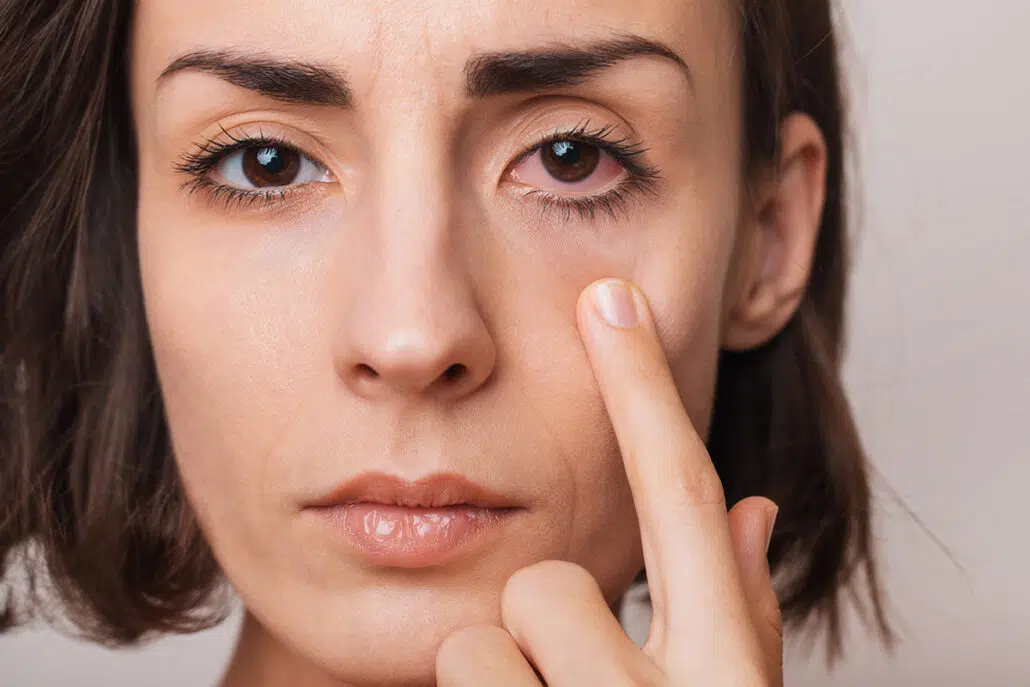 Female patient showcasing her dry eye due to allergies.