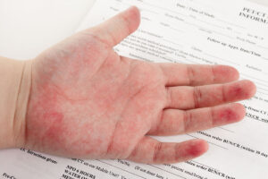 There are different types of latex allergy tests, including skin prick tests and blood tests, which are commonly used to diagnose and confirm latex allergies.