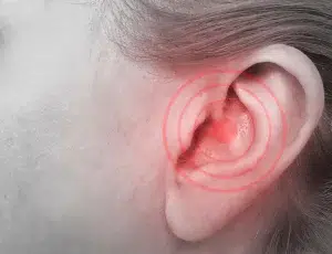 Allergy-induced hearing loss is often reversible once allergies are properly treated and inflammation subsides.