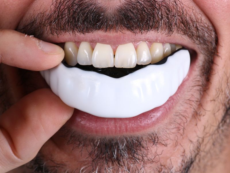Close-up of a man inserting a custom oral appliance over his teeth to manage sleep apnea.
