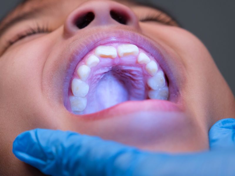 Close-up of a patient's open mouth during an oral examination by a gloved healthcare professional.