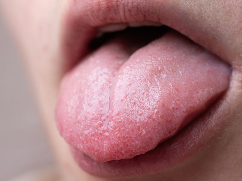 Close-up of an extended tongue, highlighting the texture and size in relation to airway obstruction.