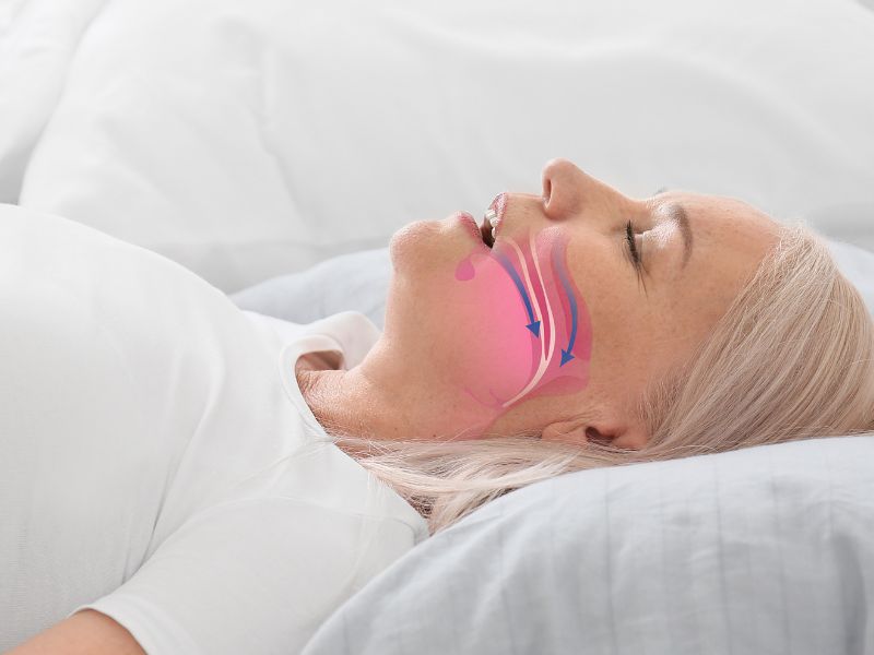 Woman lying on her back with an illustration of airflow obstruction in the throat due to sleep apnea.