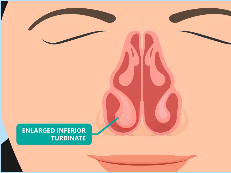 Illustration of nasal anatomy highlighting an enlarged inferior turbinate before a turbinate reduction procedure.