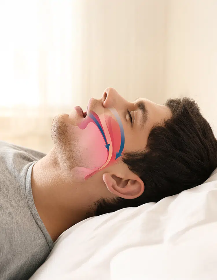 Man lying in bed with airway diagram overlay, illustrating evaluation for oral appliance candidacy in sleep apnea cases.