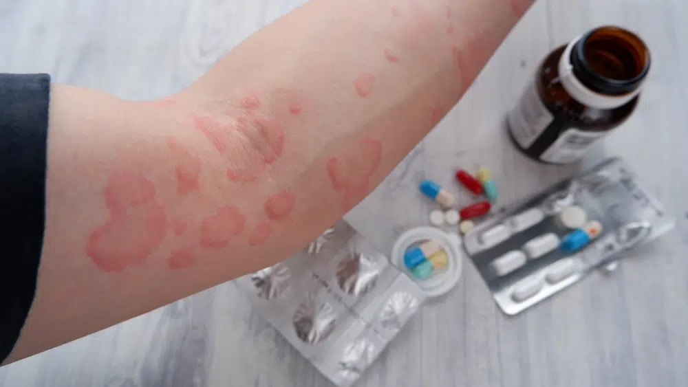 Allergy rash from medication.