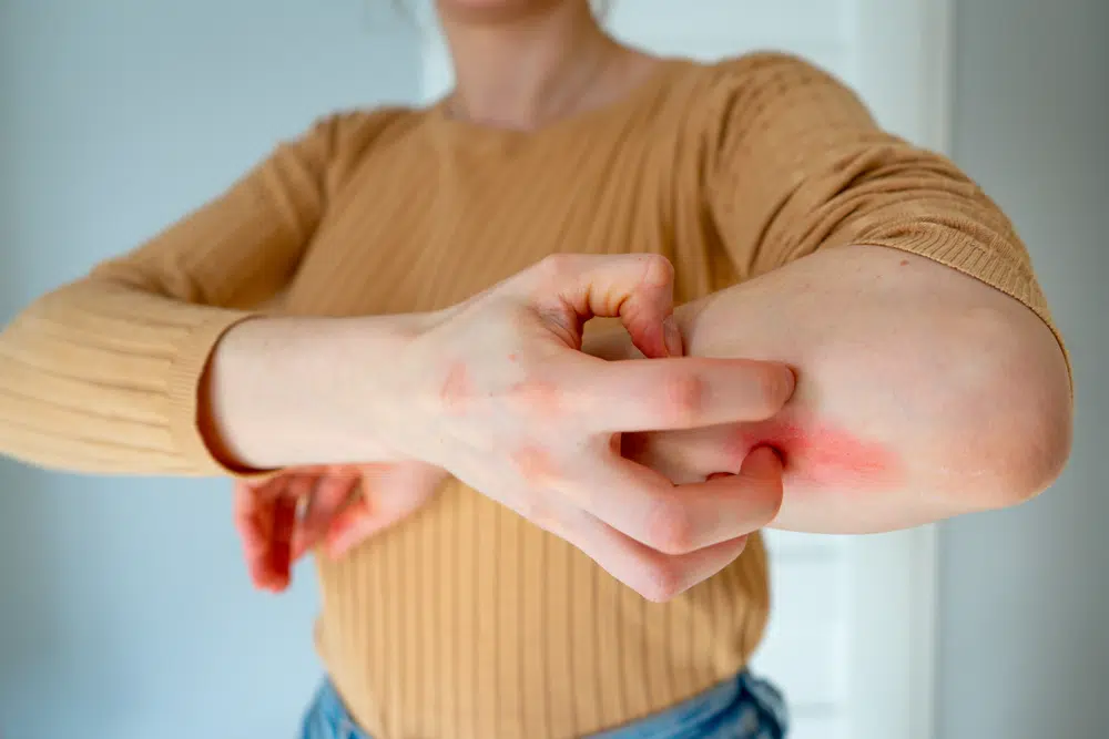 girl with allergic reaction to drug medication