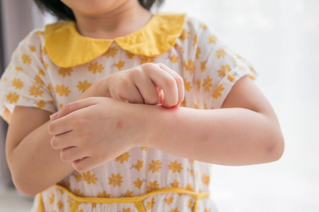 Child in yellow floral dress scratching her arm due to an allergic skin reaction related to food allergies.