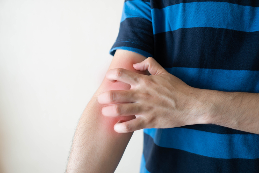 Person scratching arm while wearing striped shirt, illustrating skin rash caused by alcohol intolerance or allergic reaction.