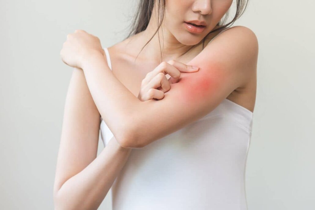 Woman examining red itchy rash on her upper arm, a common symptom indicating need for allergy testing.