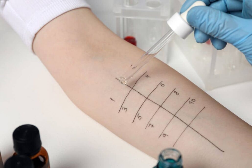 Close-up of skin prick allergy test on forearm with numbered grid and allergen drops for reaction evaluation.