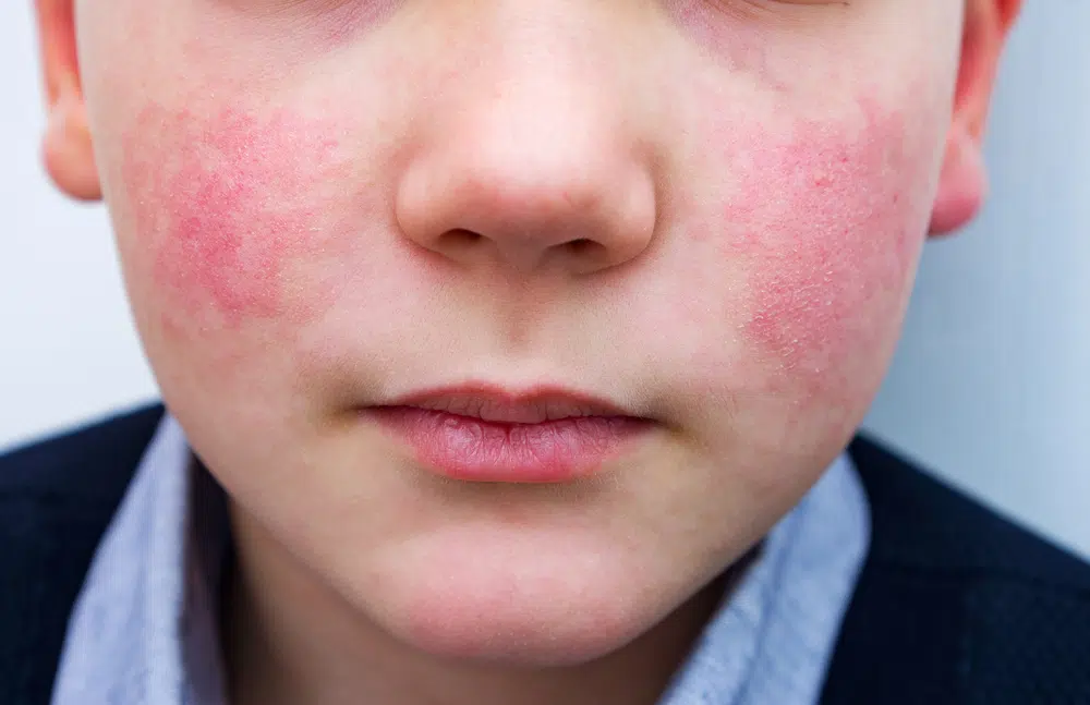 Child with red, irritated cheeks due to cold urticaria, a skin reaction caused by exposure to cold temperatures.