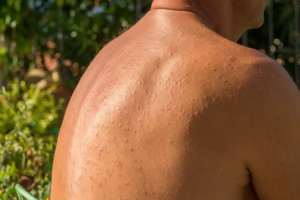 Close-up of a person's bare back in sunlight showing signs of sun allergy or photosensitivity skin reaction.