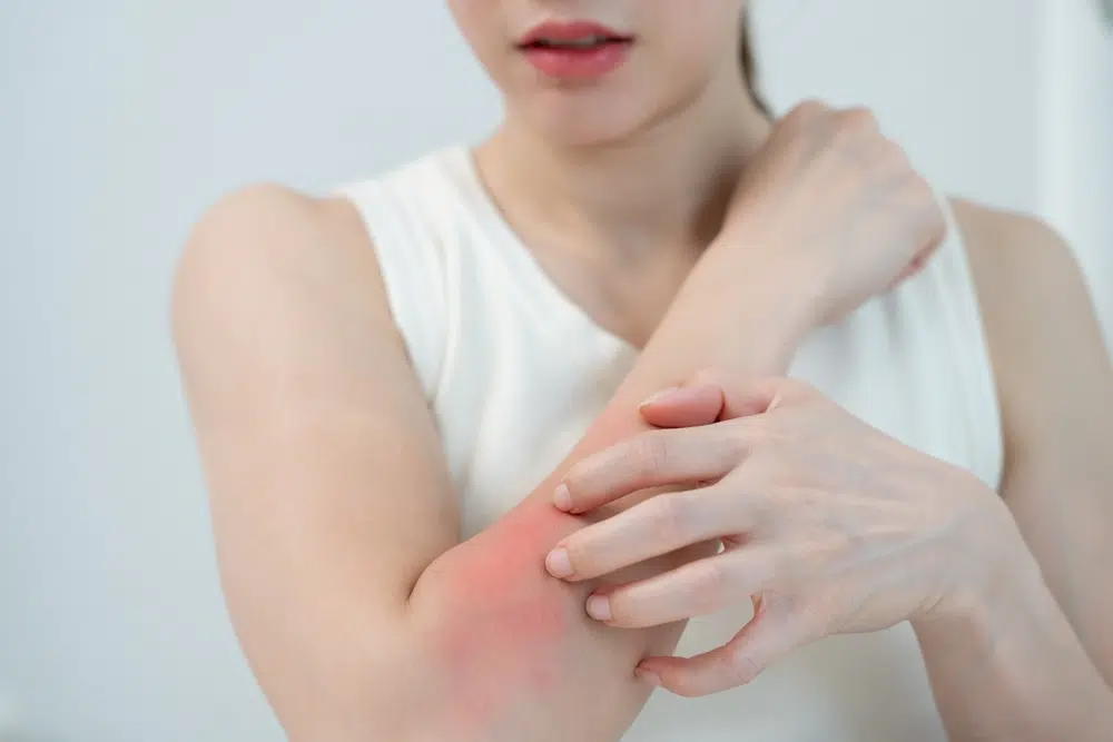 Woman scratching red, irritated skin on arm due to allergic reaction, highlighting signs of serious allergy symptoms.