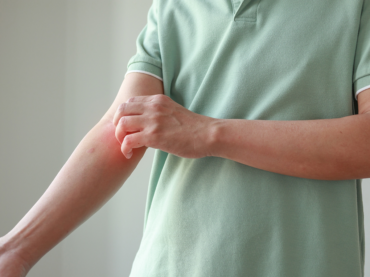 Person scratching an irritated arm, representing allergy symptoms and long-term relief through immunotherapy treatment.