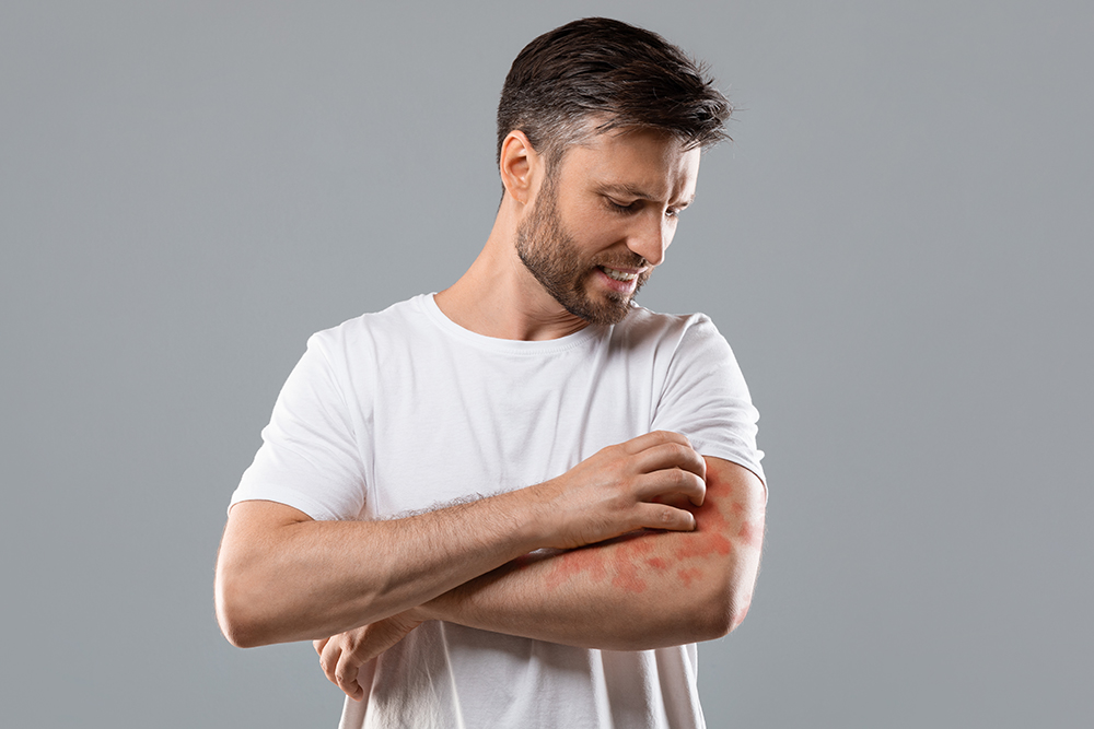 Man scratching red allergic rash on arm, showing common skin allergy symptoms and irritation.
