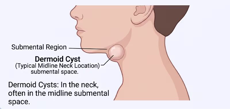 Medical diagram showing a dermoid cyst in the submental neck region near the midline area.