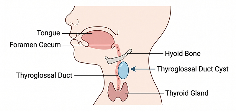 Medical diagram showing a thyroglossal duct cyst near the thyroid gland and hyoid bone in the neck.