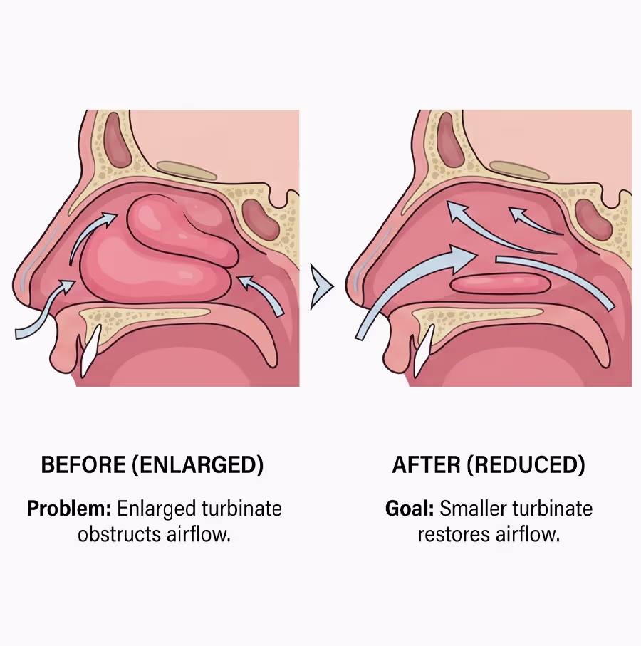 Before-and-after diagram showing turbinate reduction improving nasal airflow and reducing nasal obstruction.